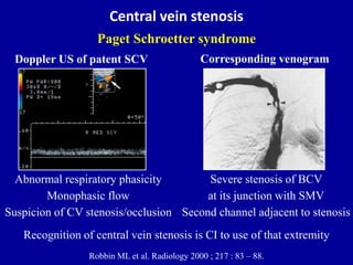 Central vein stenosis
Paget Schroetter syndrome
Robbin ML et al. Radiology 2000 ; 217 : 83 – 88.
Doppler US of patent SCV
...