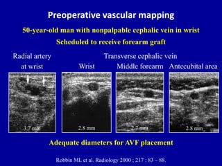 Preoperative vascular mapping
Robbin ML et al. Radiology 2000 ; 217 : 83 – 88.
50-year-old man with nonpalpable cephalic v...