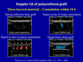 Doppler US of polyurethane graft
Three-layered material – Cannulation within 24 h
Wiese P et al. Nephrol Dial Transplant 2...