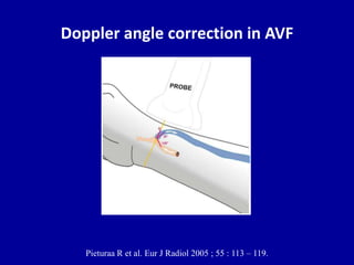 Doppler angle correction in AVF
Pieturaa R et al. Eur J Radiol 2005 ; 55 : 113 – 119.
 