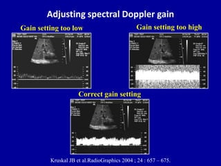 Adjusting spectral Doppler gain
Gain setting too low
Correct gain setting
Gain setting too high
Kruskal JB et al.RadioGrap...