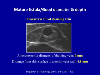 Mature fistula/Good diameter & depth
Anteroposterior diameter of draining vein: 6 mm
Distance from skin surface to anterior vein wall: 4.8 mm
Singh P et al. Radiology 2008 ; 246 : 299 – 305.
Transverse US of draining vein
 