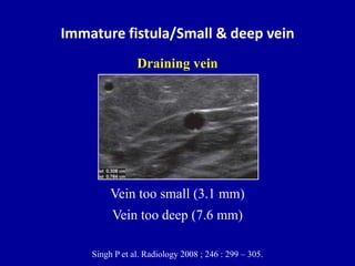 Immature fistula/Small & deep vein
Draining vein
Vein too small (3.1 mm)
Vein too deep (7.6 mm)
Singh P et al. Radiology 2008 ; 246 : 299 – 305.
 