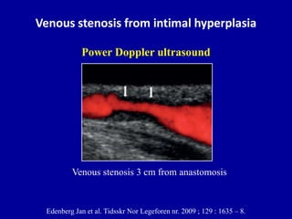 Venous stenosis from intimal hyperplasia
Edenberg Jan et al. Tidsskr Nor Legeforen nr. 2009 ; 129 : 1635 – 8.
Venous stenosis 3 cm from anastomosis
Power Doppler ultrasound
 