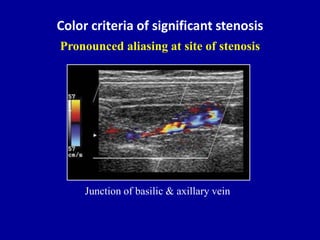 Color criteria of significant stenosis
Pronounced aliasing at site of stenosis
Junction of basilic & axillary vein
 