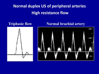 Normal duplex US of peripheral arteries
High resistance flow
Normal brachial arteryTriphasic flow
 