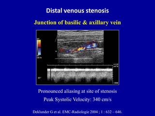 Distal venous stenosis
Deklunder G et al. EMC-Radiologie 2004 ; 1 : 632 – 646.
Pronounced aliasing at site of stenosis
Peak Systolic Velocity: 340 cm/s
Junction of basilic & axillary vein
 