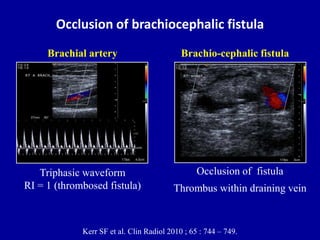 Occlusion of brachiocephalic fistula
Triphasic waveform
RI = 1 (thrombosed fistula)
Brachial artery
Occlusion of fistula
T...