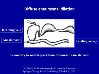 Diffuse aneurysmal dilation
Schäberle W. Ultrasonography in vascular diagnosis.
Springer-Verlag, Berlin Heidelberg, 2nd ed...