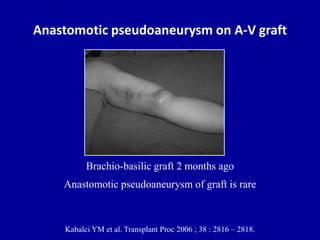 Anastomotic pseudoaneurysm on A-V graft
Kabalci YM et al. Transplant Proc 2006 ; 38 : 2816 – 2818.
Brachio-basilic graft 2...