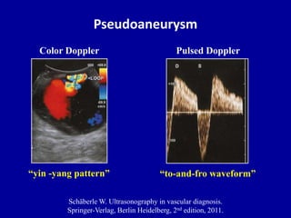 Pseudoaneurysm
Color Doppler
“yin -yang pattern”
Pulsed Doppler
“to-and-fro waveform”
Schäberle W. Ultrasonography in vasc...