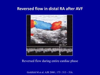 Reversed flow in distal RA after AVF
Goldfeld M et al. AJR 2000 ; 175 : 513 – 516.
Reversed flow during entire cardiac pha...