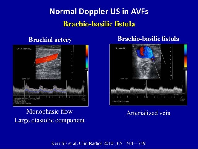 Doppler ultrasound of A-V access for hemodialysis