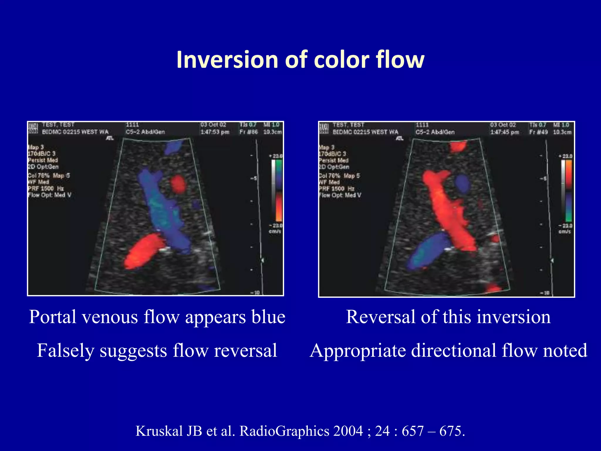 Portal Pattern Normal Doppler ultrasound of the portal system - Normal findings | PPTX