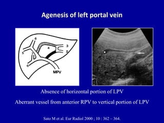 Portal Pattern Normal Normal Portal Vein Ultrasound Emory Emergency Ultrasound: December