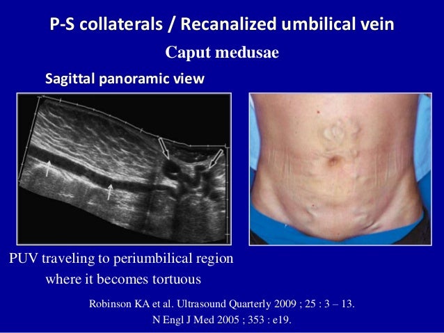 Doppler ultrasound of the portal system - Pathological findings