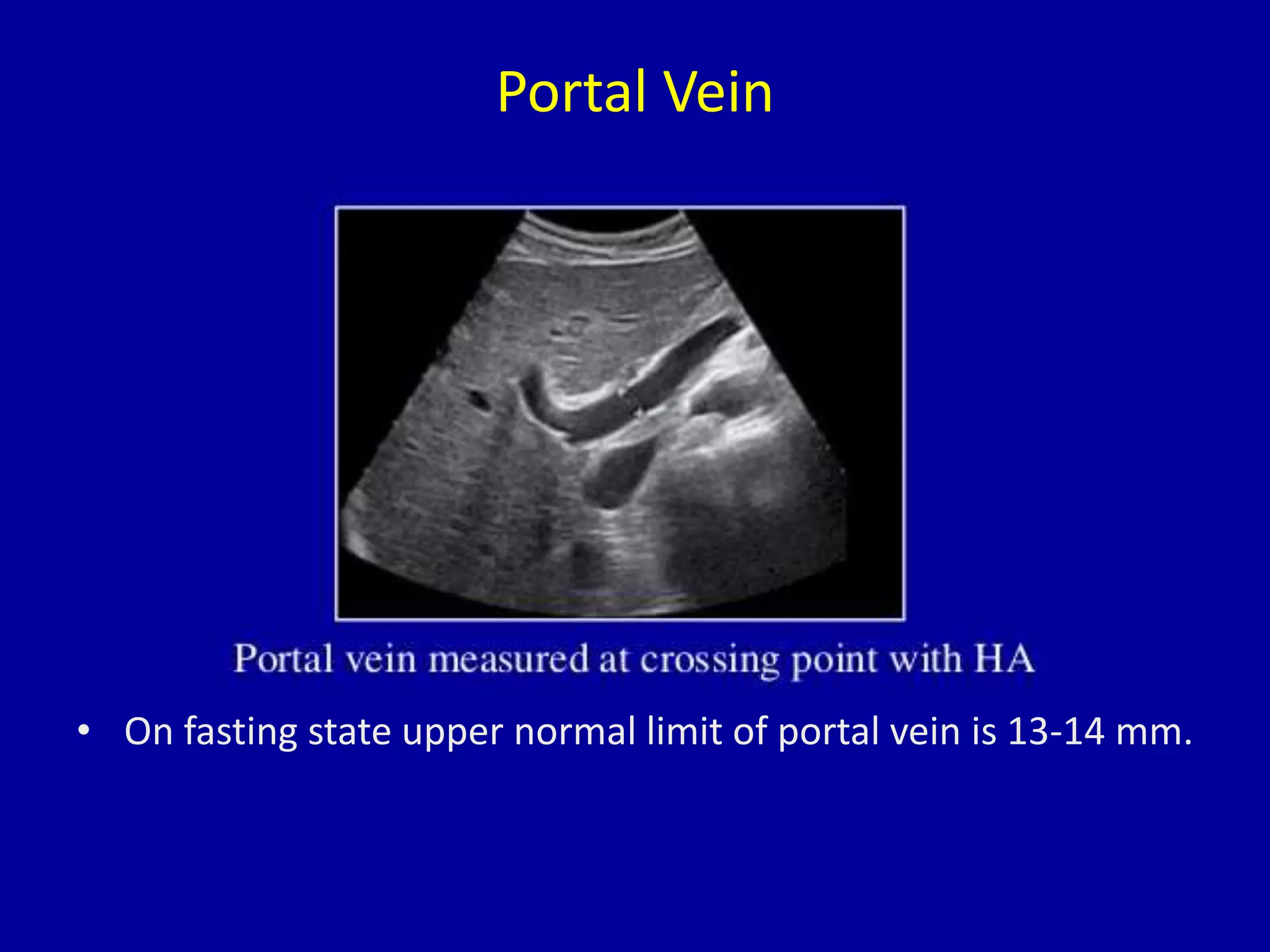 Portal Vein
• On fasting state upper normal limit of portal vein is 13-14 mm.
 