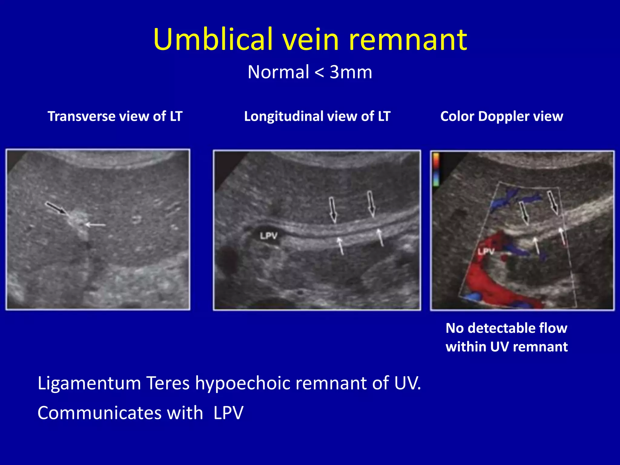 Umblical vein remnant
Normal < 3mm
Ligamentum Teres hypoechoic remnant of UV.
Communicates with LPV
Transverse view of LT Longitudinal view of LT Color Doppler view
No detectable flow
within UV remnant
 