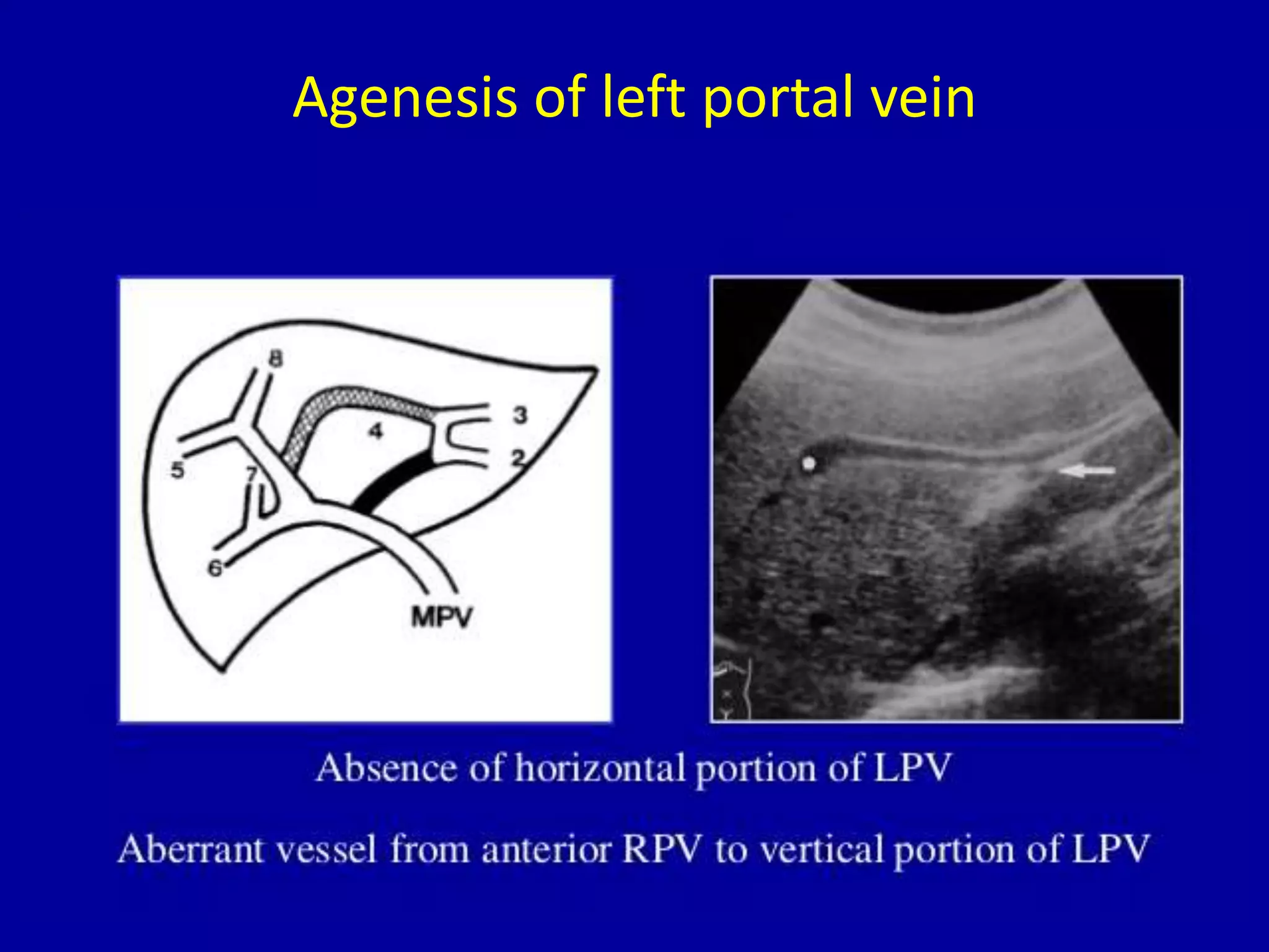 Agenesis of left portal vein
 