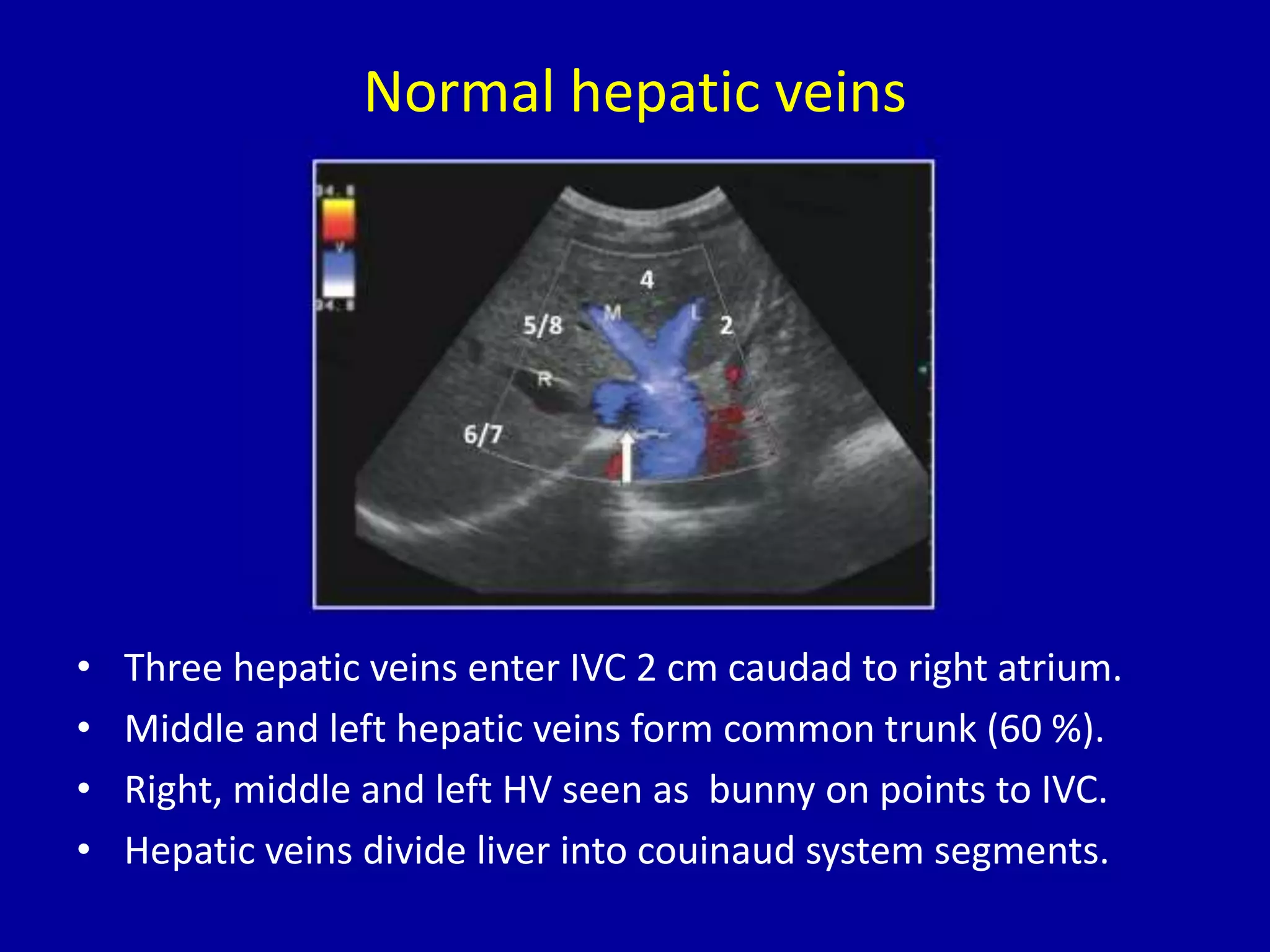 Normal hepatic veins
• Three hepatic veins enter IVC 2 cm caudad to right atrium.
• Middle and left hepatic veins form common trunk (60 %).
• Right, middle and left HV seen as bunny on points to IVC.
• Hepatic veins divide liver into couinaud system segments.
 