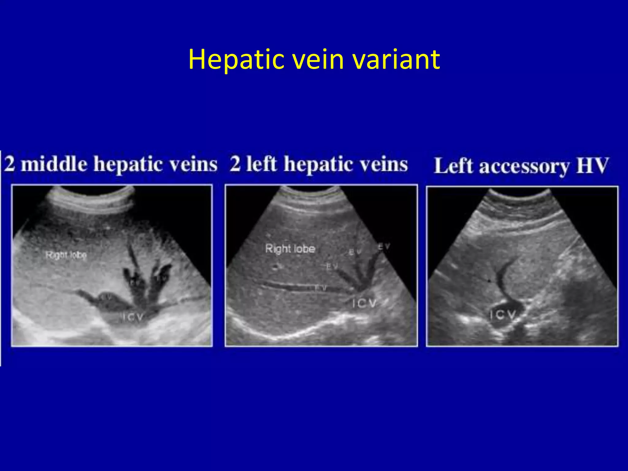 Hepatic vein variant
 