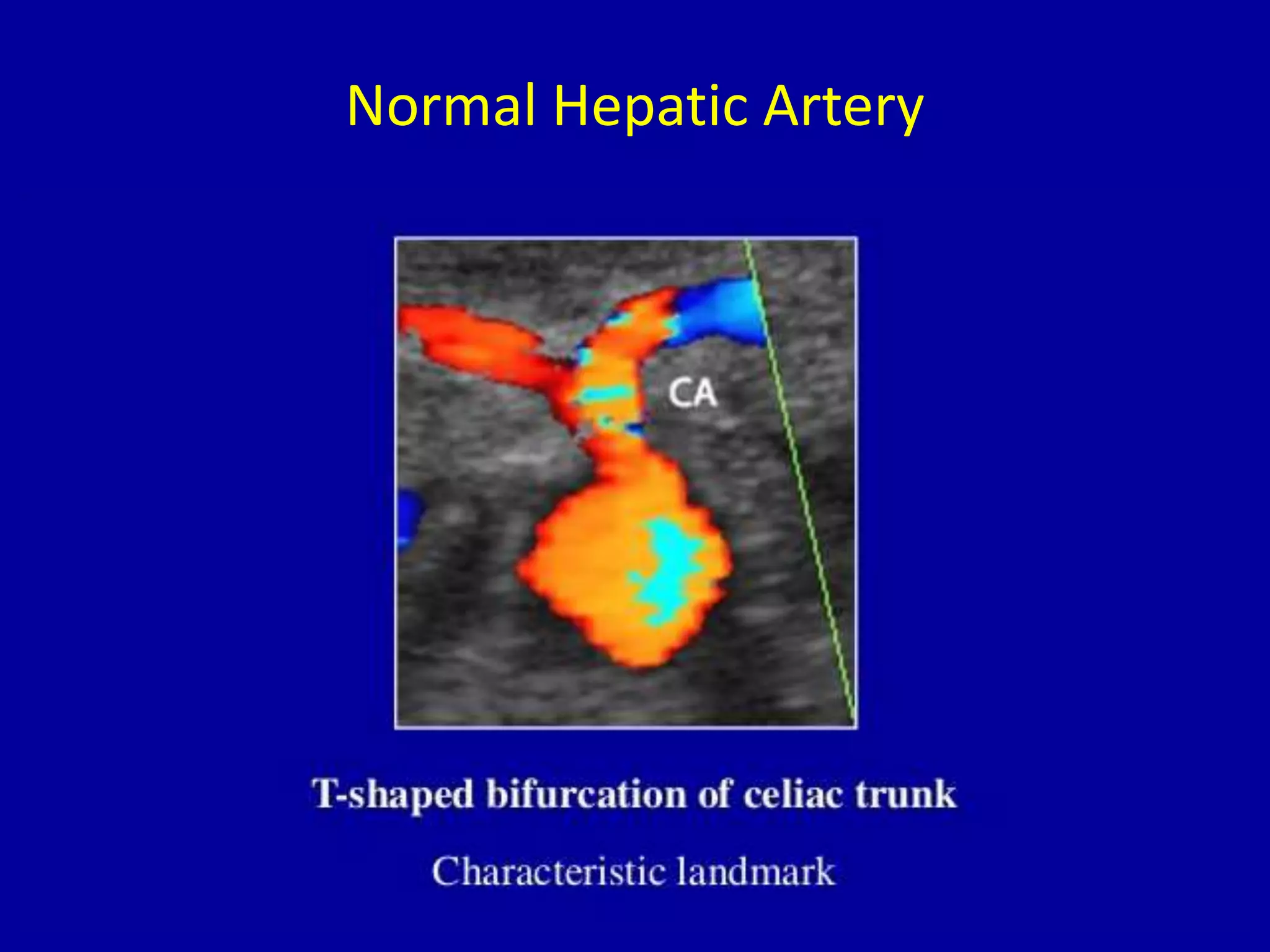 Normal Hepatic Artery
 