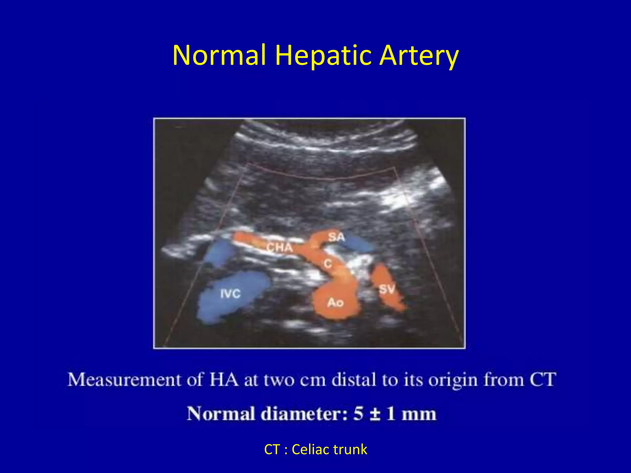 Normal Hepatic Artery
CT : Celiac trunk
 