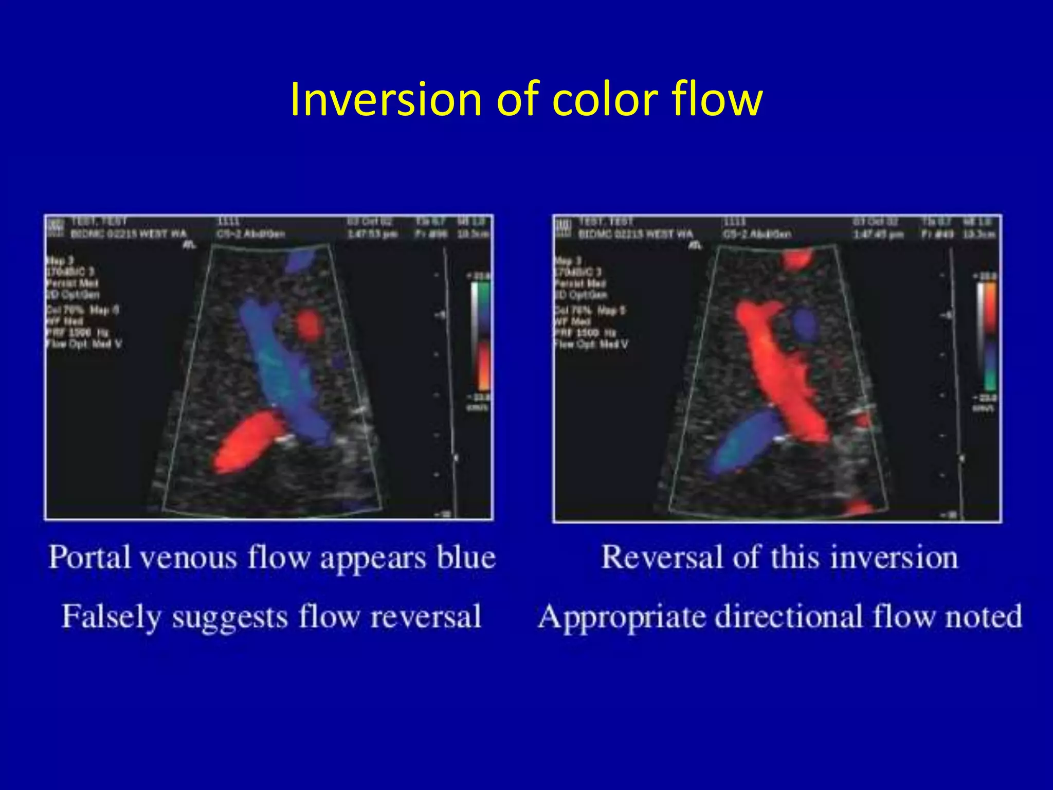 Inversion of color flow
 