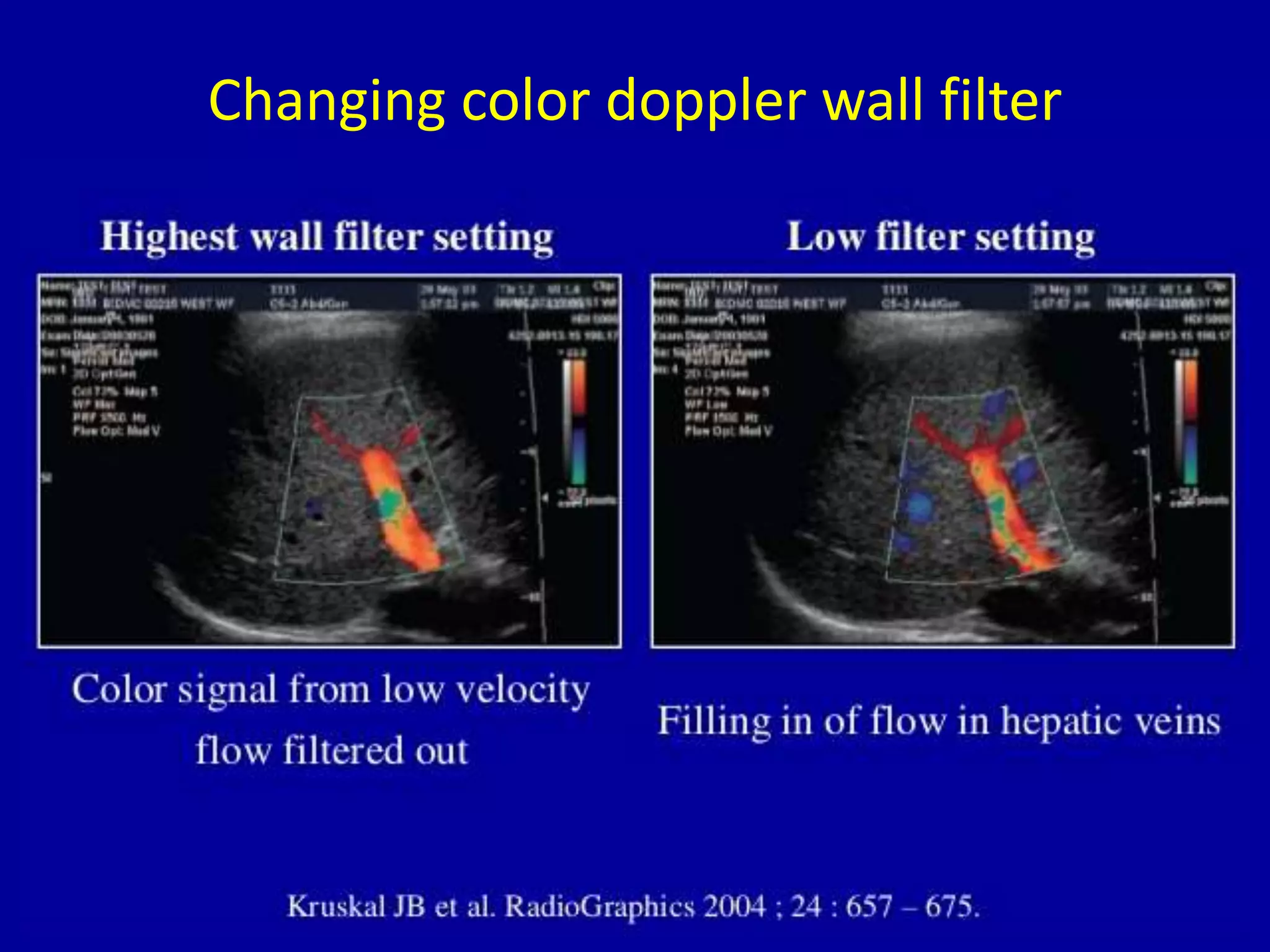 Changing color doppler wall filter
 