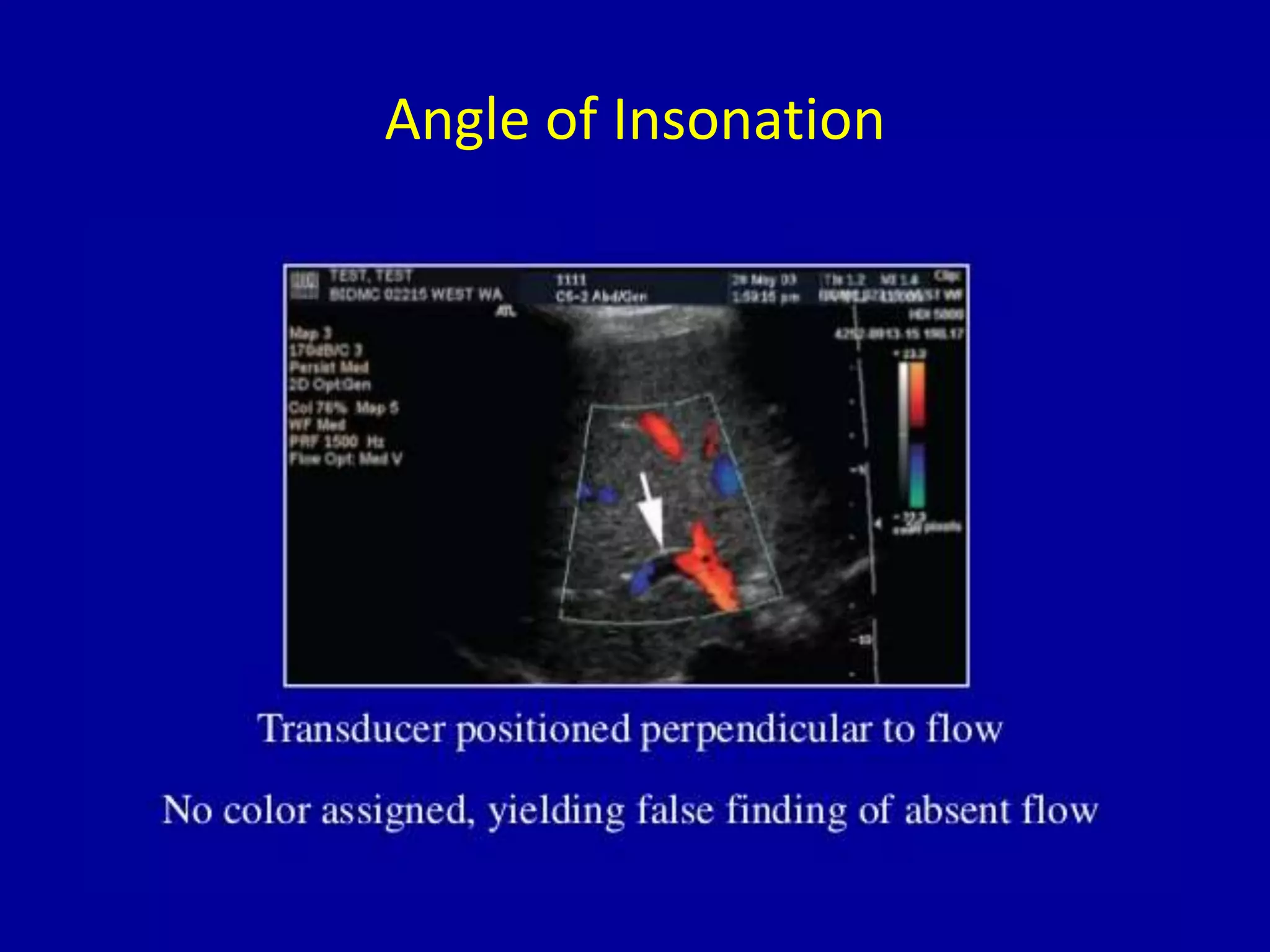 Angle of Insonation
 