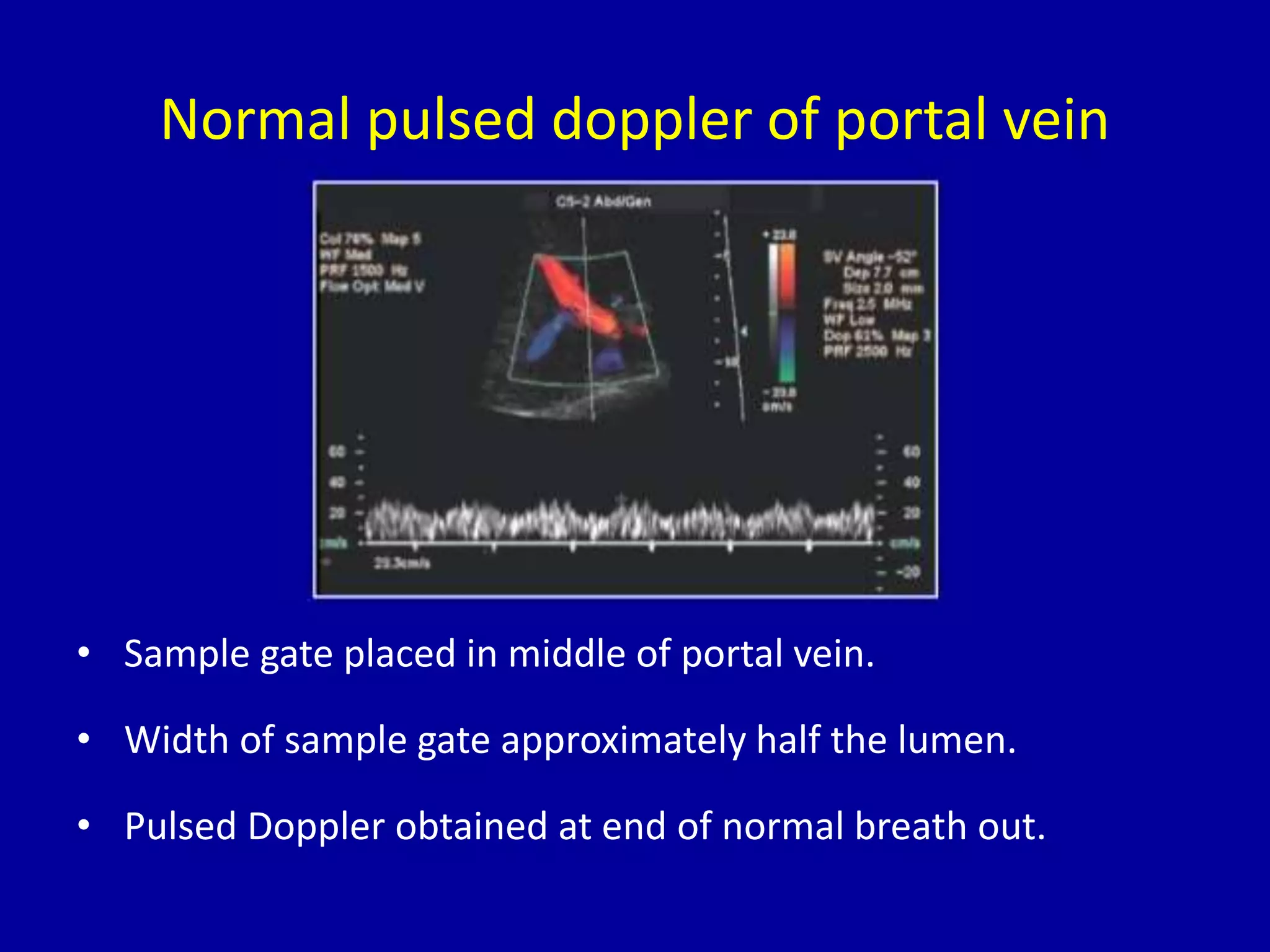 Normal pulsed doppler of portal vein
• Sample gate placed in middle of portal vein.
• Width of sample gate approximately half the lumen.
• Pulsed Doppler obtained at end of normal breath out.
 