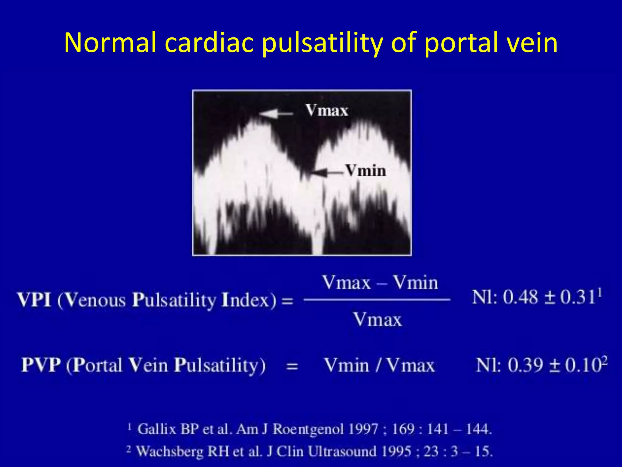 Normal cardiac pulsatility of portal vein
 