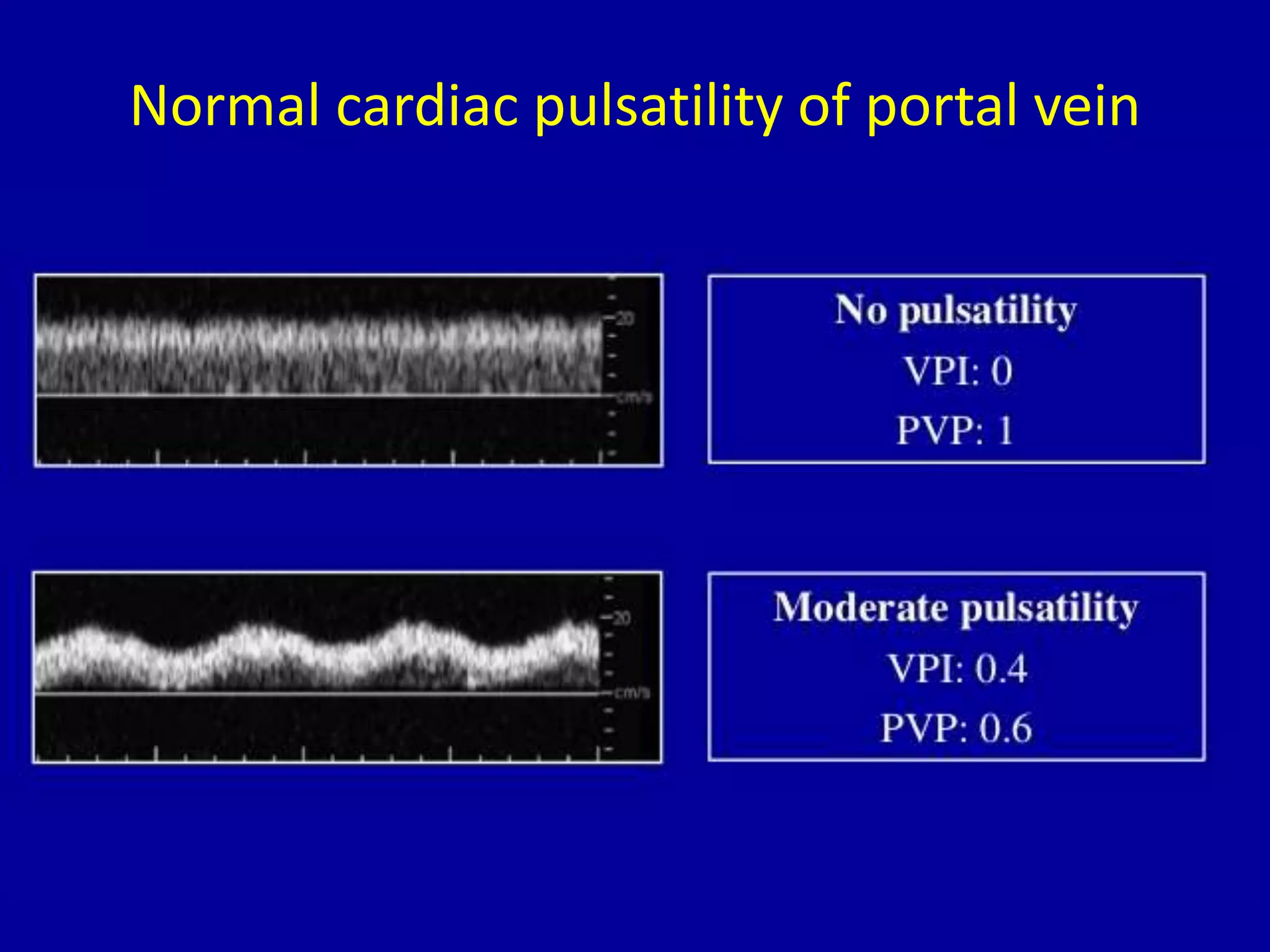 Normal cardiac pulsatility of portal vein
 