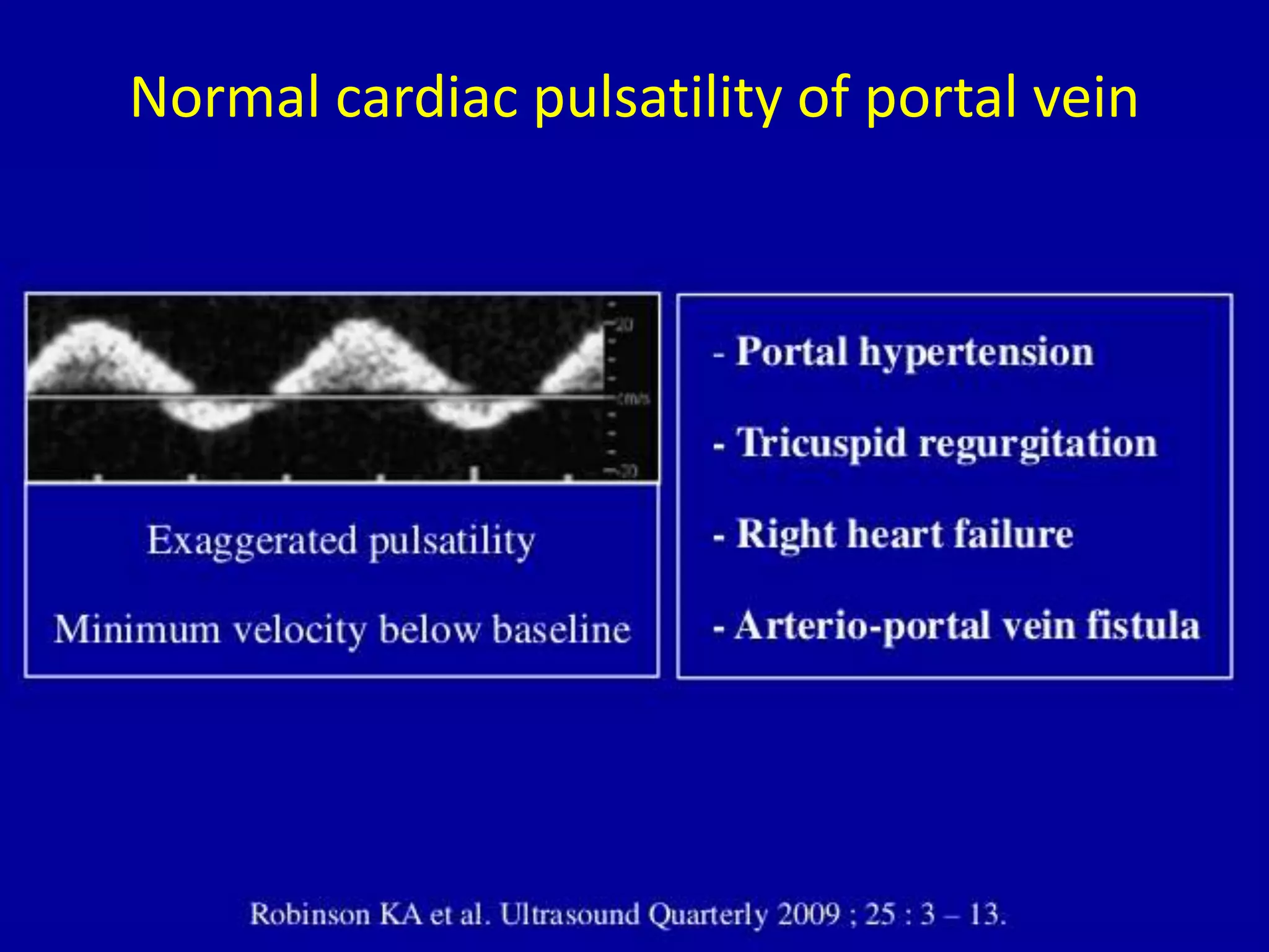 Normal cardiac pulsatility of portal vein
 
