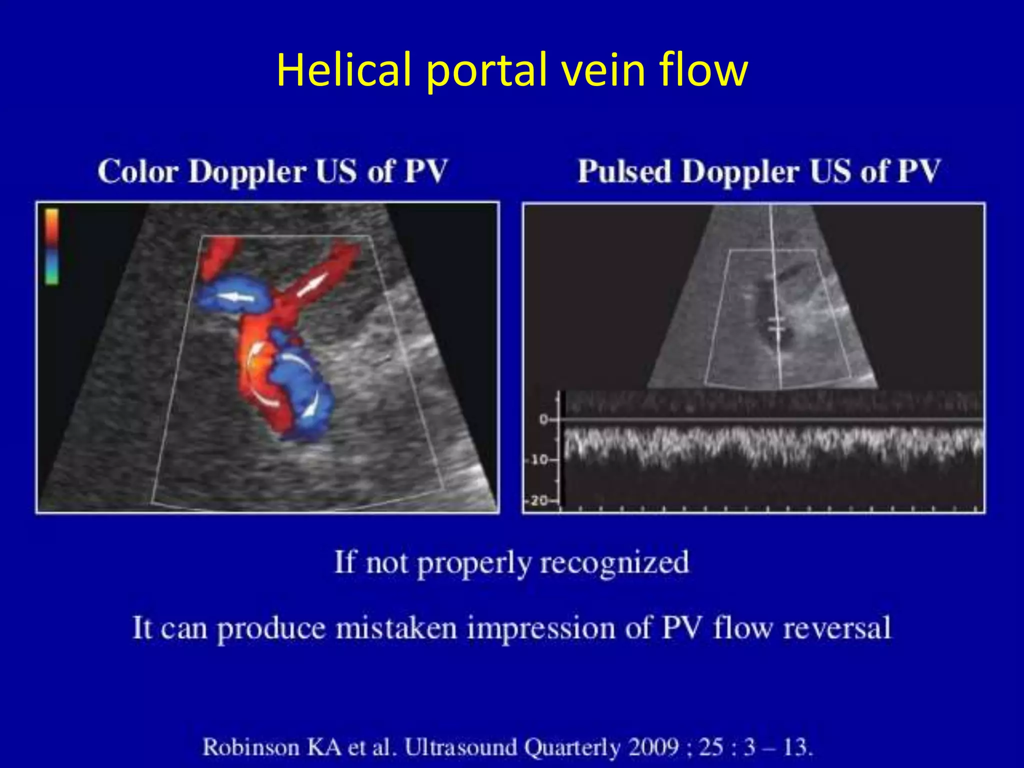 Helical portal vein flow
 