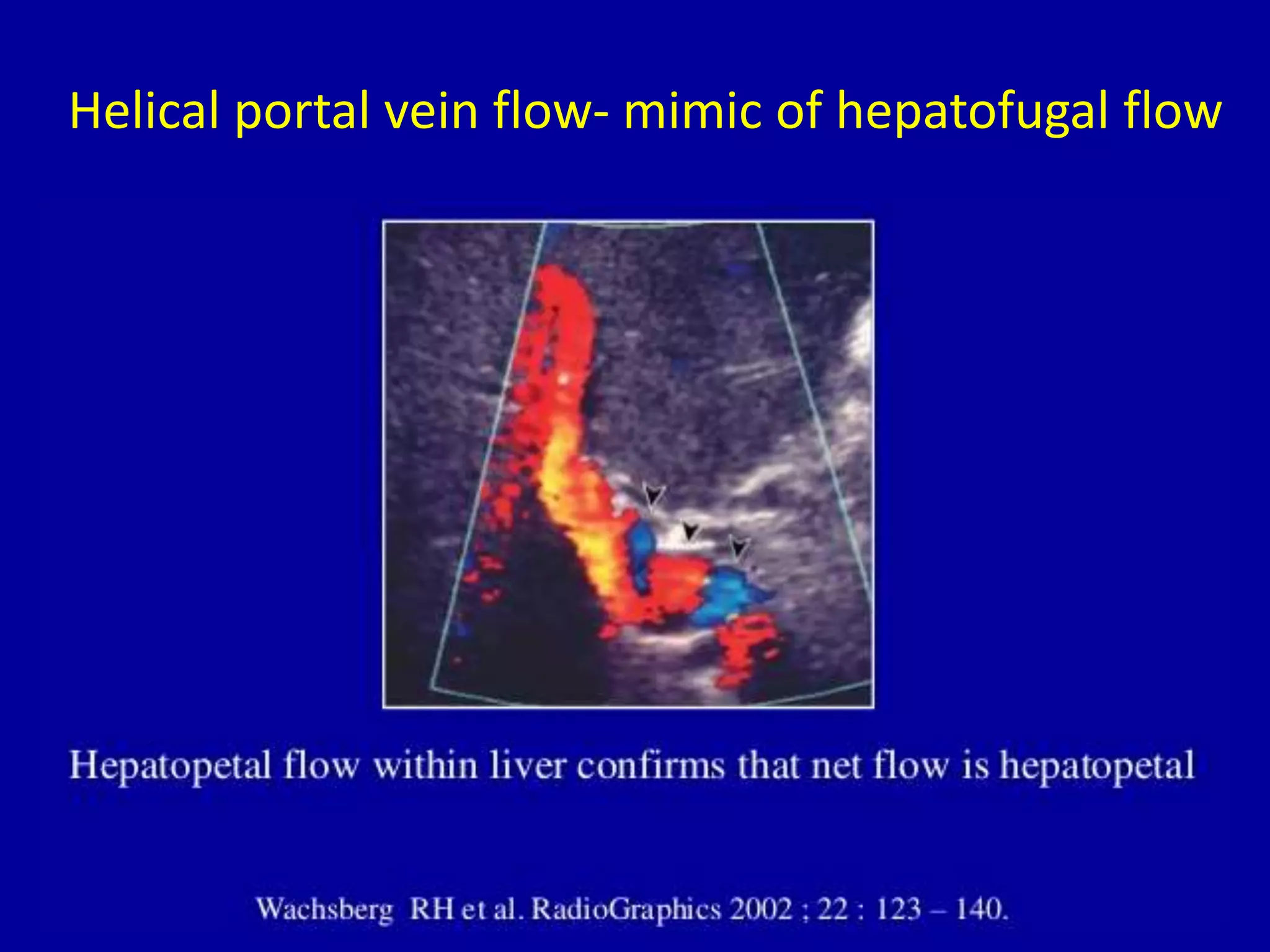 Helical portal vein flow- mimic of hepatofugal flow
 