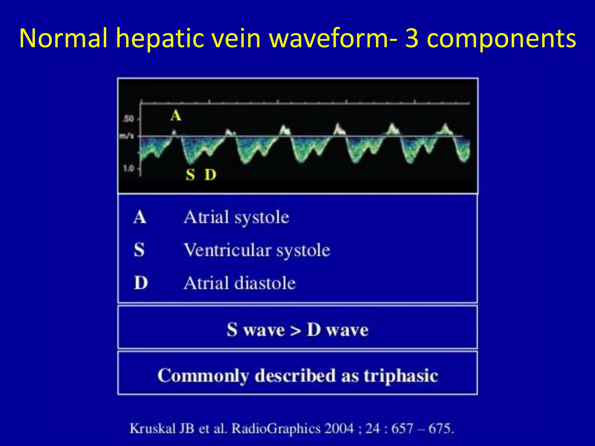 Normal hepatic vein waveform- 3 components
 