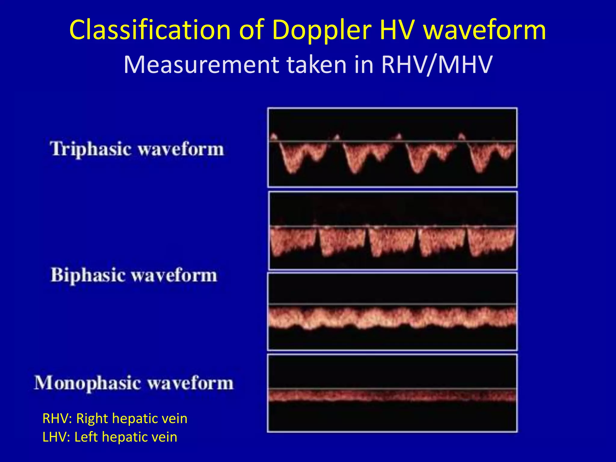 Classification of Doppler HV waveform
Measurement taken in RHV/MHV
RHV: Right hepatic vein
LHV: Left hepatic vein
 
