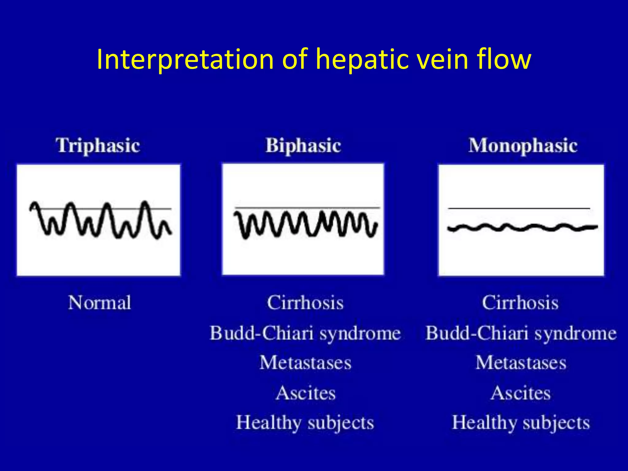 Interpretation of hepatic vein flow
 