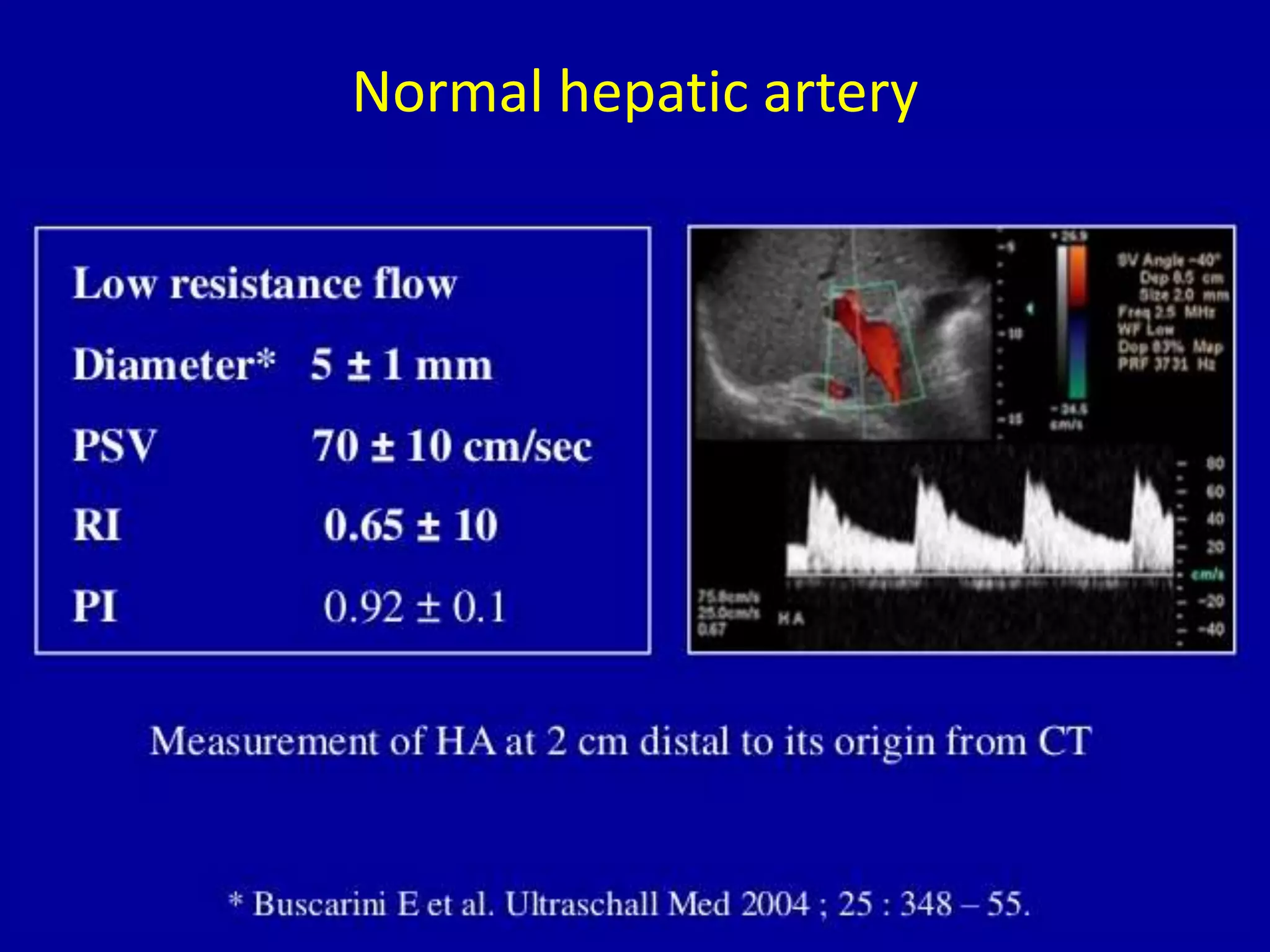 Normal hepatic artery
 