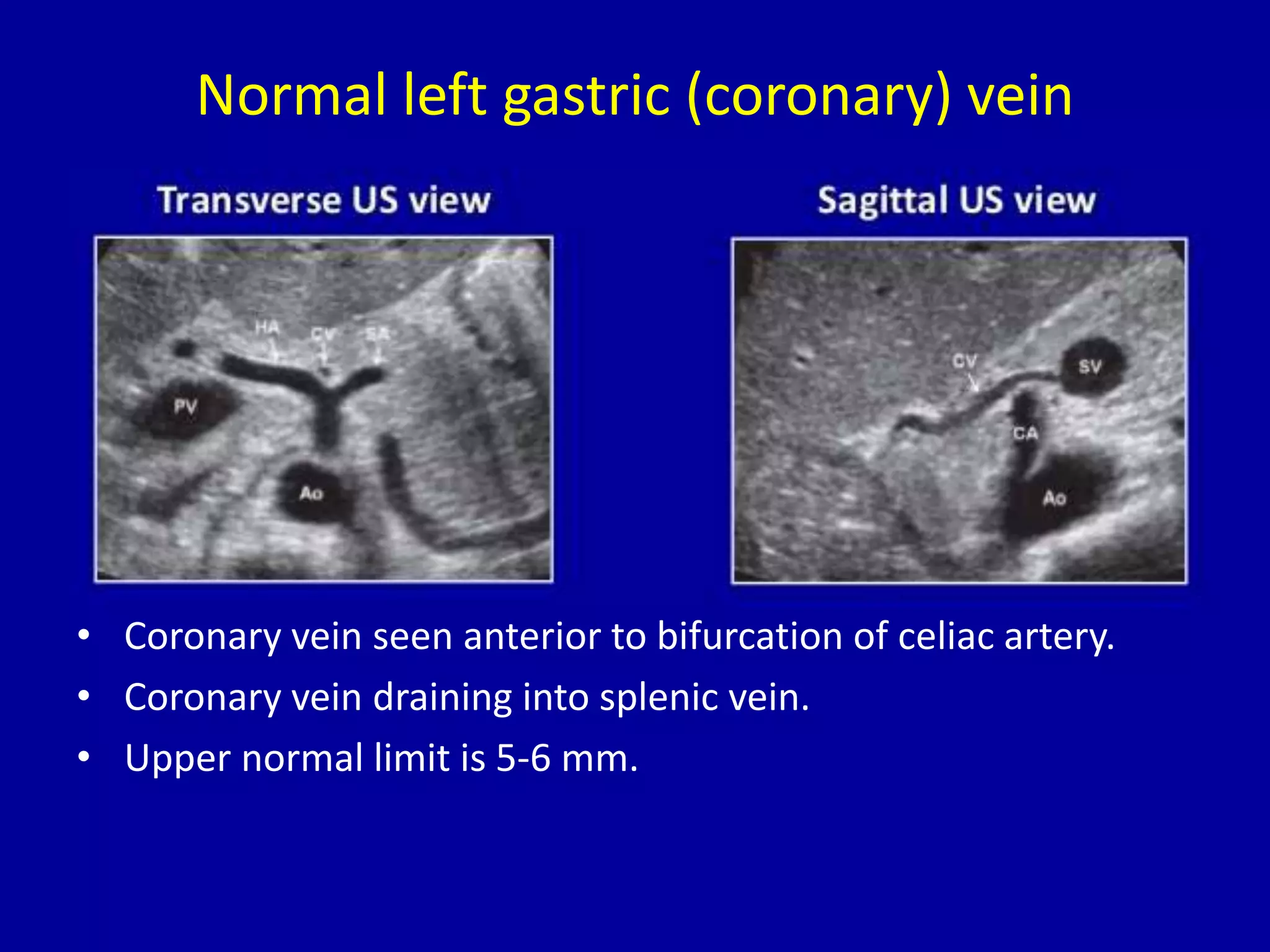 Normal left gastric (coronary) vein
• Coronary vein seen anterior to bifurcation of celiac artery.
• Coronary vein draining into splenic vein.
• Upper normal limit is 5-6 mm.
 