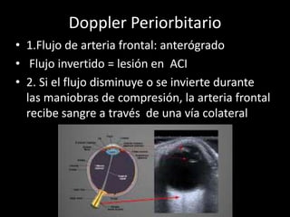 Doppler Periorbitario
• 1.Flujo de arteria frontal: anterógrado
• Flujo invertido = lesión en ACI
• 2. Si el flujo disminuye o se invierte durante
las maniobras de compresión, la arteria frontal
recibe sangre a través de una vía colateral
 