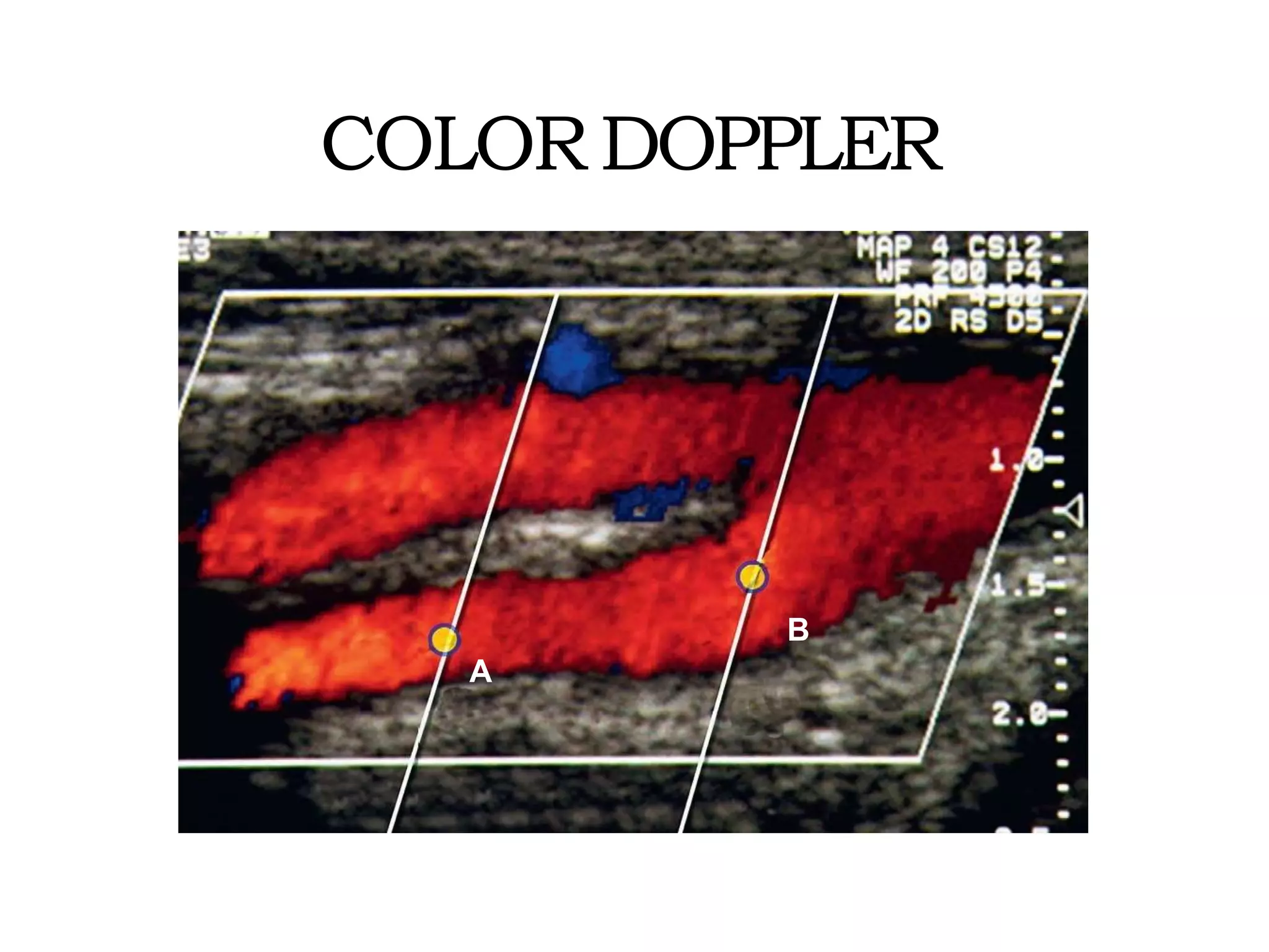 Color Doppler Ultrasound - Basic physics | PPTX