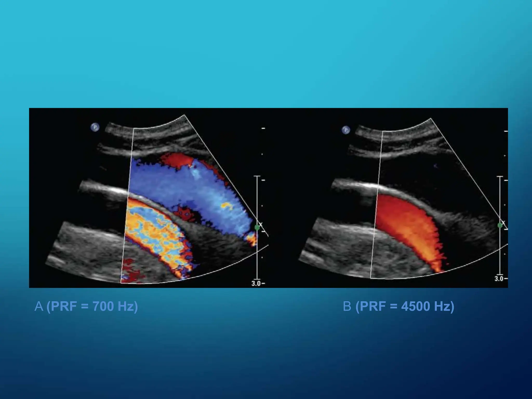A (PRF = 700 Hz) B (PRF = 4500 Hz)
 