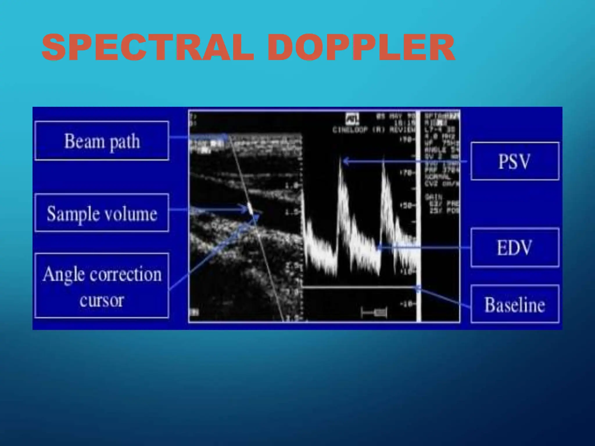 SPECTRAL DOPPLER
 