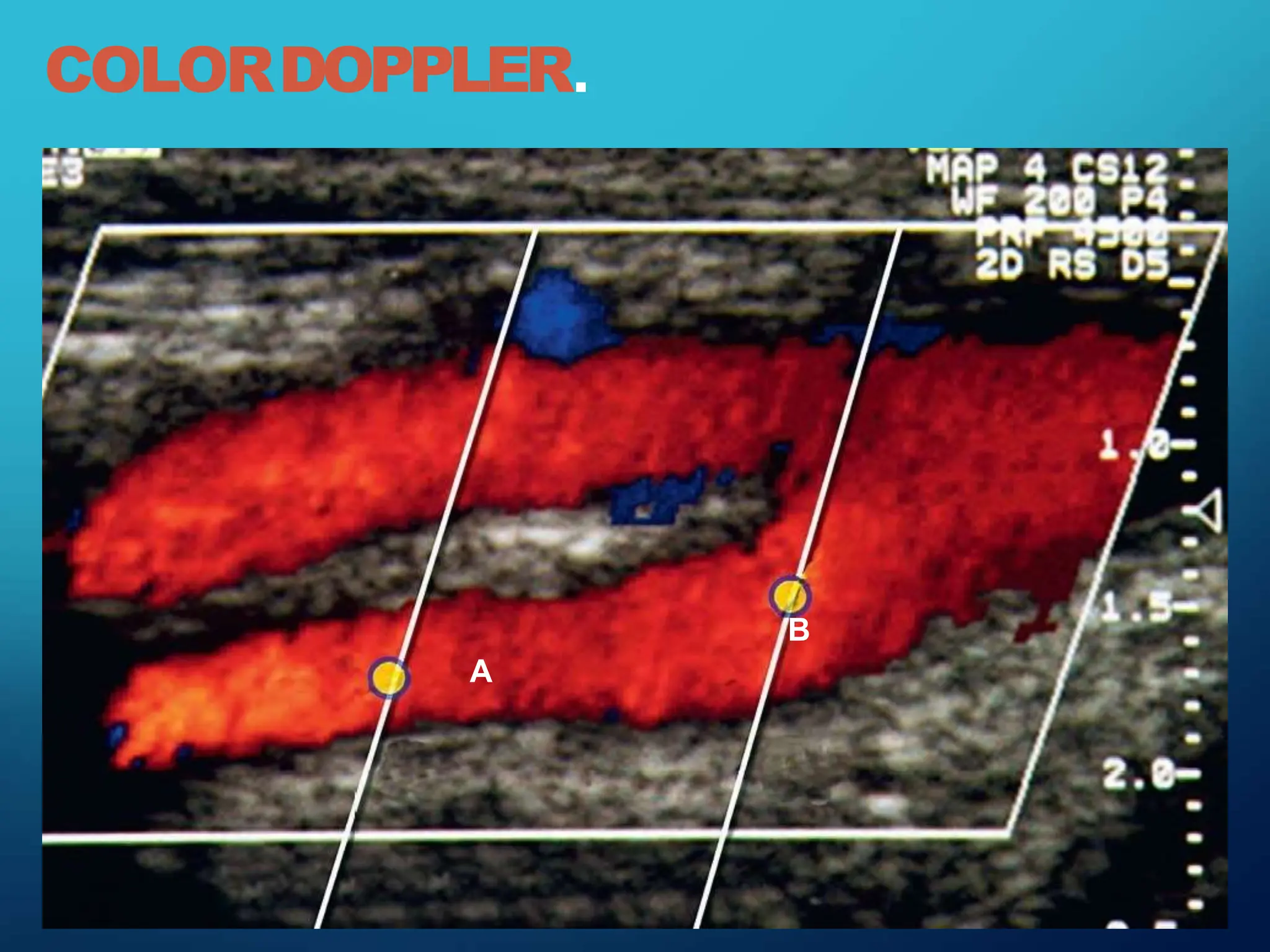 COLORDOPPLER.
B
A
 