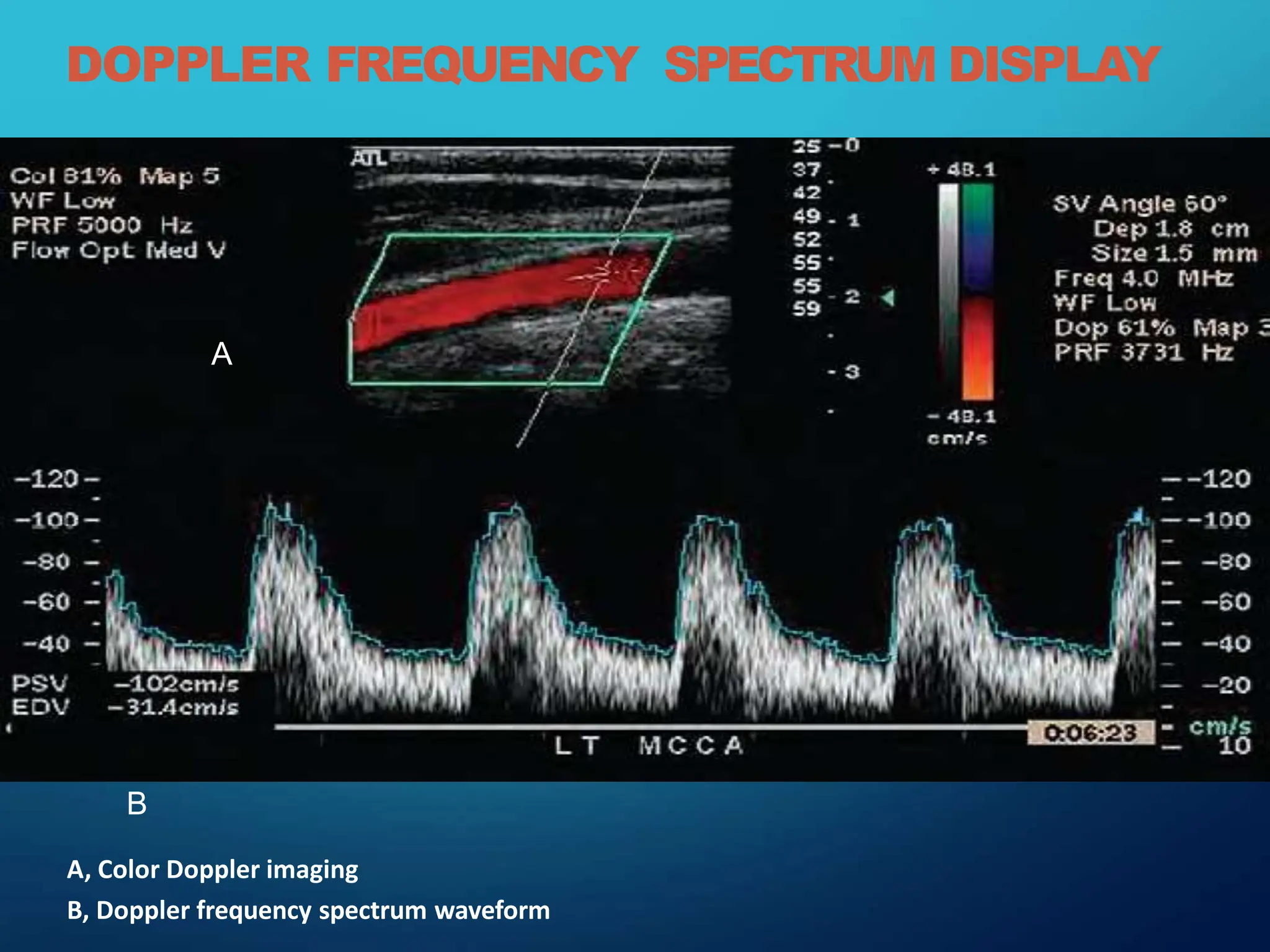 DOPPLER FREQUENCY SPECTRUM DISPLAY
B
A, Color Doppler imaging
B, Doppler frequency spectrum waveform
A
 