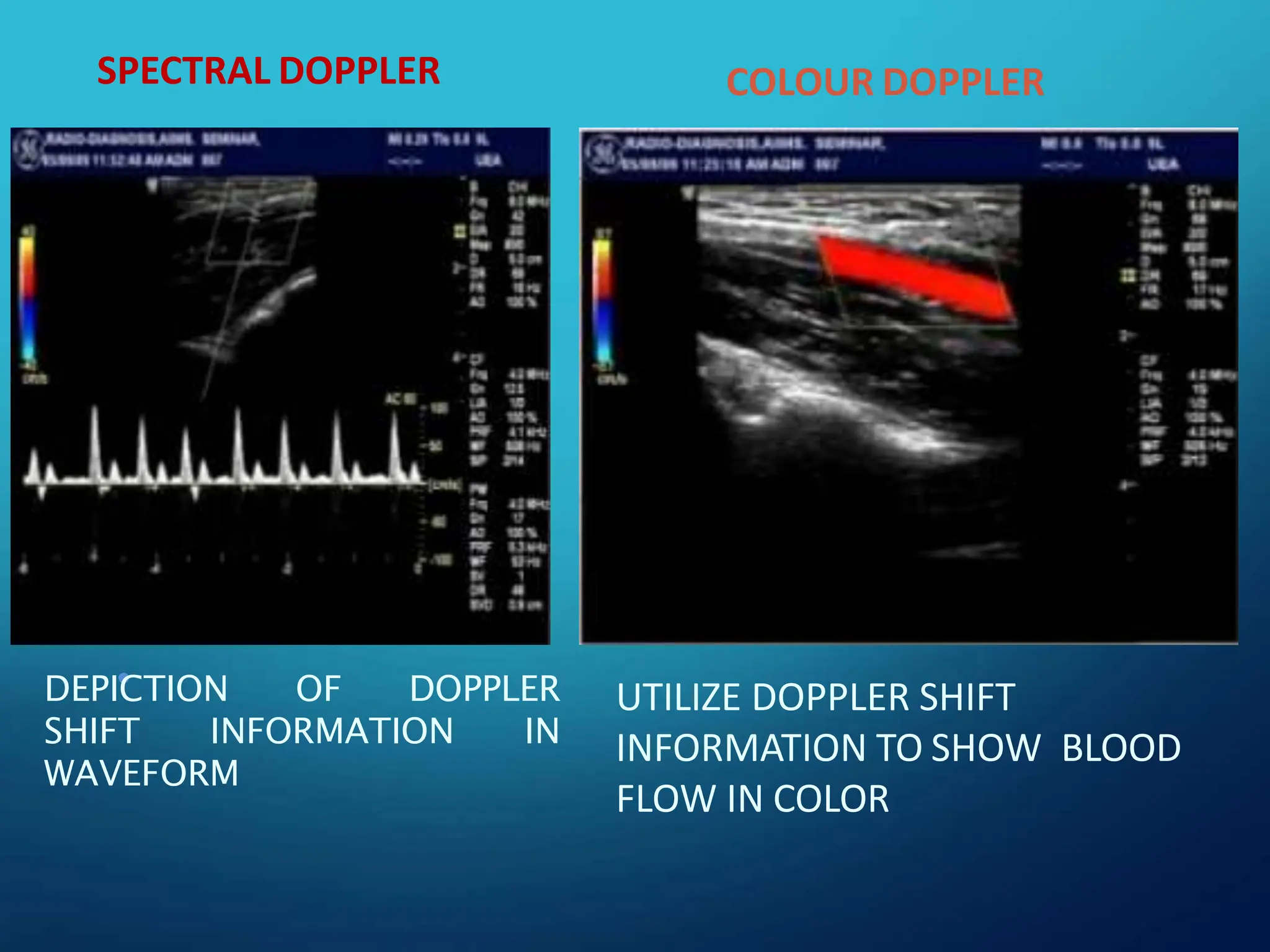 SPECTRAL DOPPLER
•
DEPICTION OF DOPPLER
SHIFT INFORMATION IN
WAVEFORM
COLOUR DOPPLER
UTILIZE DOPPLER SHIFT
INFORMATION TO SHOW BLOOD
FLOW IN COLOR
 