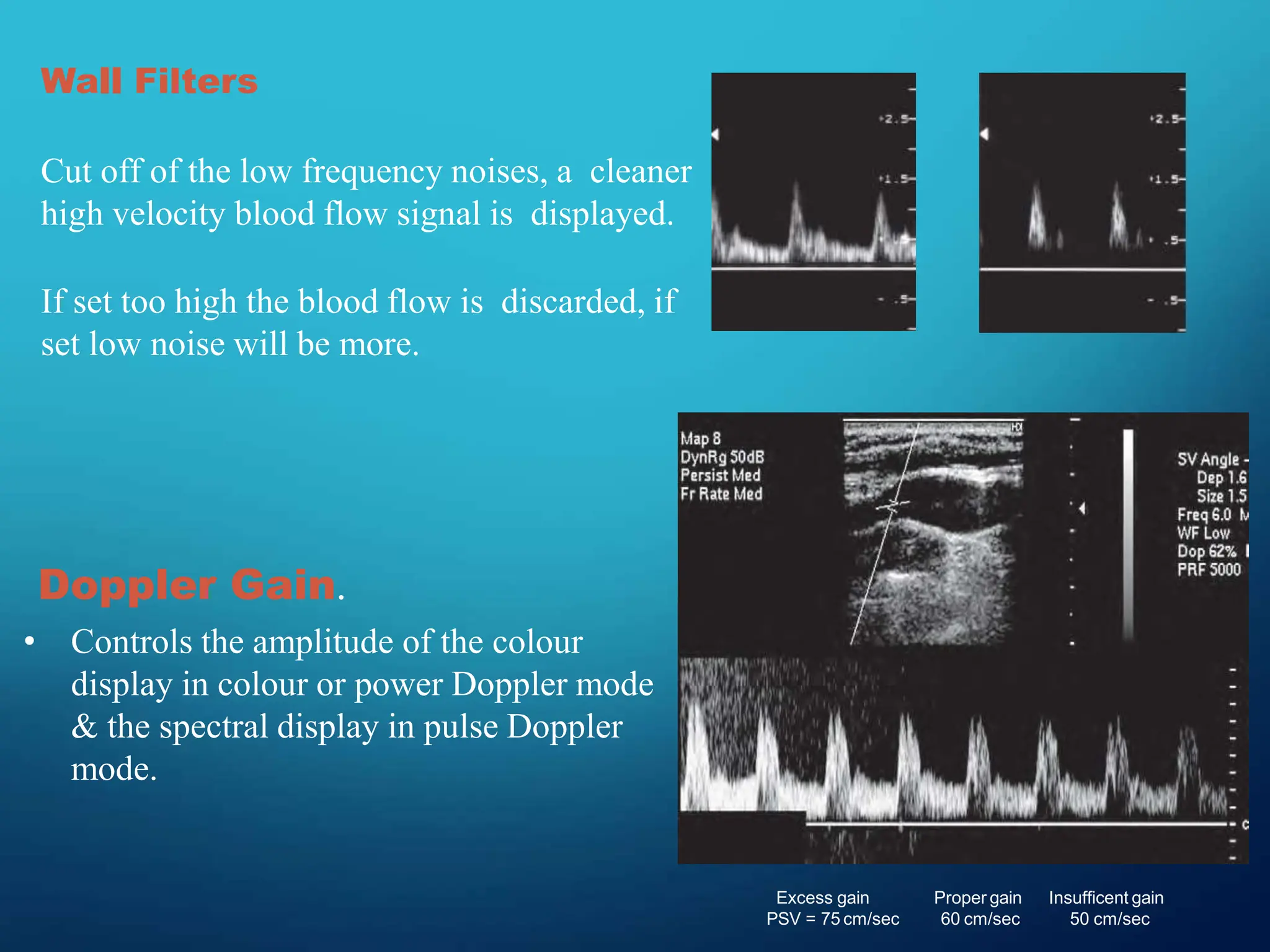 Wall Filters
Cut off of the low frequency noises, a cleaner
high velocity blood flow signal is displayed.
If set too high the blood flow is discarded, if
set low noise will be more.
Doppler Gain.
• Controls the amplitude of the colour
display in colour or power Doppler mode
& the spectral display in pulse Doppler
mode.
Excess gain
PSV = 75 cm/sec
Proper gain
60 cm/sec
Insufficent gain
50 cm/sec
 