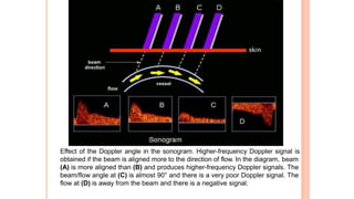 Effect of the Doppler angle in the sonogram. Higher-frequency Doppler signal is
obtained if the beam is aligned more to the direction of flow. In the diagram, beam
(A) is more aligned than (B) and produces higher-frequency Doppler signals. The
beam/flow angle at (C) is almost 90° and there is a very poor Doppler signal. The
flow at (D) is away from the beam and there is a negative signal.
 